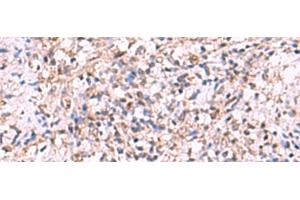 Immunohistochemistry of paraffin-embedded Human cervical cancer tissue using LMCD1 Polyclonal Antibody at dilution of 1:100(x200) (LMCD1 抗体)