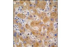 Formalin-fixed and paraffin-embedded human hepatocarcinoma tissue reacted with APOA4 antibody (N-term), which was peroxidase-conjugated to the secondary antibody, followed by DAB staining. (APOA4 抗体  (C-Term, N-Term))