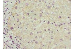 Immunohistochemistry of paraffin-embedded human liver cancer using ABIN7145588 at dilution of 1:100 (BAAT 抗体  (AA 309-418))