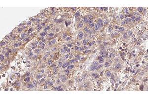 ABIN6276326 at 1/100 staining Human Melanoma tissue by IHC-P. (Midkine 抗体  (Internal Region))