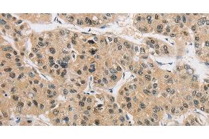 Immunohistochemistry of paraffin-embedded Human liver cancer tissue using AMZ2 Polyclonal Antibody at dilution 1:40 (AMZ2 抗体)