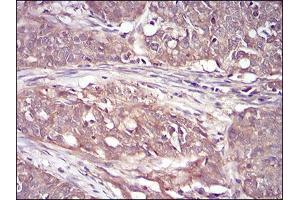 Immunohistochemical analysis of paraffin-embedded cervical cancer tissues using RPS6KA2 mouse mAb with DAB staining.