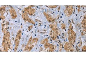 Immunohistochemistry of paraffin-embedded Human breast cancer tissue using CLEC1A Polyclonal Antibody at dilution 1:40 (CLEC1A 抗体)