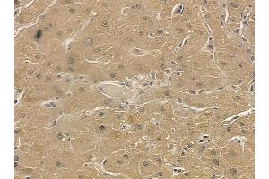 TRAM1 Mouse Monoclonal Antibody at 1/100 staining human liver cancer by IHC-P. (TRAM1 抗体)