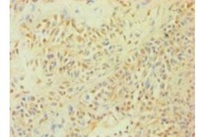 Immunohistochemistry of paraffin-embedded human breast cancer using ABIN7146925 at dilution of 1:100 (Caspase 1 抗体  (AA 120-269))