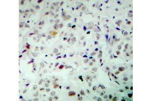 Immunohistochemistry (IHC) image for anti-Retinoblastoma 1 (RB1) (pSer780) antibody (ABIN1681996) (Retinoblastoma 1 抗体  (pSer780))