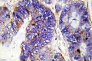 Immunohistochemistry (IHC) analyzes of COL4A2 antibody in paraffin-embedded human colon carcinoma tissue. (COL4a2 抗体  (Chain alpha 2))