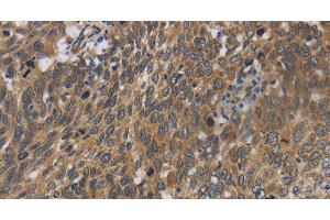 Immunohistochemistry of paraffin-embedded Human cervical cancer using Cytochrome b5 Polyclonal Antibody at dilution of 1:40 (Cytochrome b5 (CYTB5) 抗体)