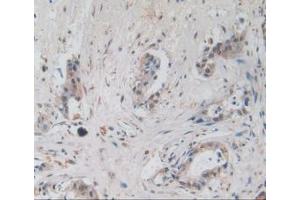 IHC-P analysis of Human Pancreas Cancer Tissue, with DAB staining. (Amphiregulin 抗体  (AA 20-100))