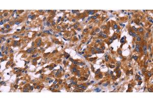 Immunohistochemistry of paraffin-embedded Human thyroid cancer tissue using KIR2DL1/3/4/S4 Polyclonal Antibody at dilution 1:30 (KIR2DL1/3/4/S4 抗体)