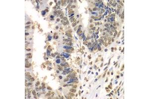 Immunohistochemistry of paraffin-embedded human colon carcinoma using HDAC2 antibody. (HDAC2 抗体  (C-Term))