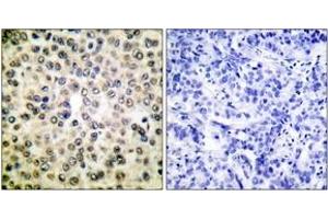 Immunohistochemistry analysis of paraffin-embedded human breast carcinoma tissue, using NF-kappaB p65 (Ab-310) Antibody. (NF-kB p65 抗体  (AA 275-324))