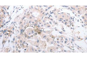 Immunohistochemistry of paraffin-embedded Human lung cancer using MMP11 Polyclonal Antibody at dilution of 1:40 (MMP11 抗体)