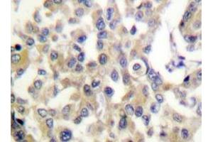 Immunohistochemistry analyzes of Vimentin antibody in paraffin-embedded human breast carcinoma tissue. (Vimentin 抗体)