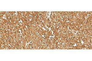 Immunohistochemistry of paraffin-embedded Human ovarian cancer tissue using GMEB2 Polyclonal Antibody at dilution of 1:35(x200) (GMEB2 抗体)