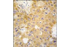 Formalin-fixed and paraffin-embedded human hepatocarcinoma tissue reacted with APH1 antibody (N-term), which was peroxidase-conjugated to the secondary antibody, followed by DAB staining. (APH1A 抗体  (N-Term))