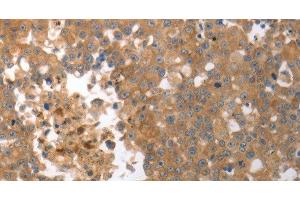 Immunohistochemistry of paraffin-embedded Human breast cancer tissue using MMP27 Polyclonal Antibody at dilution 1:50 (MMP27 抗体)