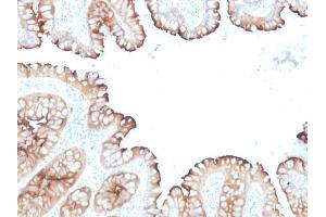 Formalin-fixed, paraffin-embedded human Colon Carcinoma stained with Villin Mouse Monoclonal Antibody (VIL1/1314 + VIL1/2376). (Villin 1 抗体  (AA 179-311))