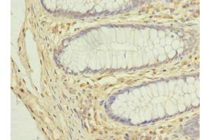 Immunohistochemistry of paraffin-embedded human colon cancer using ABIN7149138 at dilution of 1:100 (COX11 抗体  (AA 115-276))