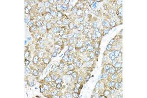 Immunohistochemistry of paraffin-embedded human liver cancer using HSP90B1 Rabbit pAb (ABIN6130434, ABIN6142031, ABIN6142033 and ABIN7101795) at dilution of 1:50 (40x lens). (GRP94 抗体  (AA 550-650))