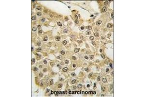Formalin-fixed and paraffin-embedded human breast carcinoma tissue reacted with the MDM2 Antibody  (ABIN388067 and ABIN2845752) , which was peroxidase-conjugated to the secondary antibody, followed by DAB staining.