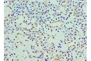 Immunohistochemistry of paraffin-embedded human breast cancer using ABIN7142608 at dilution of 1:100 (Coq7 抗体  (AA 37-217))