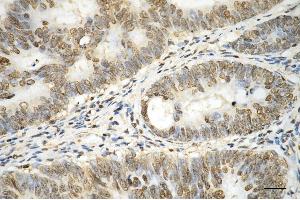 Immunohistochemistry was performed on paraffin-embedded human sigmoid colon carcinoma using histone H3 (mono methyl K14) antibody (ABIN7798958), 1:200). (Recombinant Histone 3 抗体  (H3K14me1))