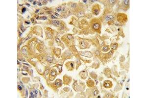 IHC analysis of FFPE human lung carcinoma tissue stained with TLR2 antibody (TLR2 抗体  (AA 212-242))