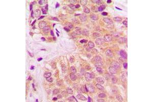 Immunohistochemical analysis of MARK4 staining in human breast cancer formalin fixed paraffin embedded tissue section. (MARK4 抗体  (Center))