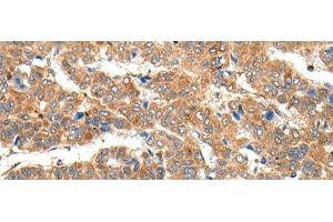 Immunohistochemistry of paraffin-embedded Human liver cancer tissue using RPL14 Polyclonal Antibody at dilution of 1:30(x200) (RPL14 抗体)