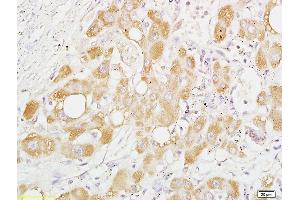 Formalin-fixed and paraffin embedded human liver carcinoma labeled with Anti-Phospho-PRAS40 (Thr246) Polyclonal Antibody, Unconjugated (ABIN744953) at 1:200 followed by conjugation to the secondary antibody and DAB staining (PRAS40 抗体  (pThr246))