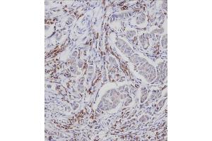Immunohistochemical analysis of A on paraffin-embedded Human breast carcinoma tissue. (CDC25A 抗体  (pSer124))