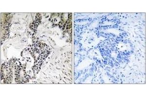 Immunohistochemistry analysis of paraffin-embedded human colon carcinoma, using CDC25C (Phospho-Ser198) Antibody. (CDC25C 抗体  (pSer198))