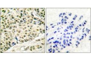 Immunohistochemistry analysis of paraffin-embedded human breast carcinoma tissue, using MCM2 Antibody. (MCM2 抗体  (AA 1-50))