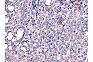 The image on the left is immunohistochemistry of paraffin-embedded Human thyroid cancer tissue using ABIN7131190(SRPK3 Antibody) at dilution 1/20, on the right is treated with fusion protein. (SRPK3 抗体)