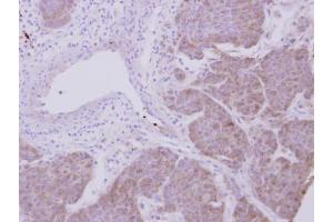 IHC-P Image Immunohistochemical analysis of paraffin-embedded human breast cancer, using Peroxiredoxin 2, antibody at 1:500 dilution. (Peroxiredoxin 2 抗体)