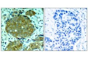 Immunohistochemical analysis of paraffin-embedded human breast carcinoma tissue, using NFκB-p105/p50 (phospho-Ser932) antibody (E011251). (NFKB1 抗体  (pSer932))