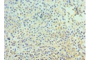Immunohistochemistry of paraffin-embedded human breast cancer using ABIN7147301 at dilution of 1:100 (CDC16 抗体  (AA 371-620))