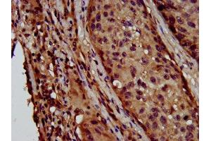 IHC image of ABIN7158792 diluted at 1:600 and staining in paraffin-embedded human lung cancer performed on a Leica BondTM system. (LAPTM4B 抗体  (AA 174-226))