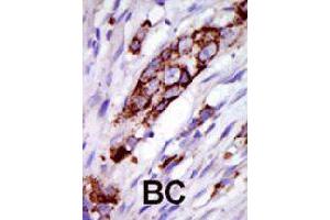 Formalin-fixed and paraffin-embedded human cancer tissue reacted with GRK5 polyclonal antibody  , which was peroxidase-conjugated to the secondary antibody, followed by DAB staining . (GRK5 抗体  (C-Term))