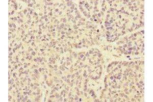 Immunohistochemistry of paraffin-embedded human ovarian cancer using ABIN7167981 at dilution of 1:100 (ARHGEF3 抗体  (AA 287-526))