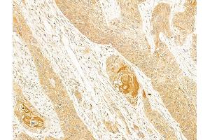 ABIN6256835 and ABIN6273684 at 1/100 staining Human esophageal cancer by IHC-P. (Cytokeratin 1 抗体  (N-Term))