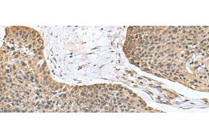 Immunohistochemistry of paraffin-embedded Human esophagus cancer tissue using NFS1 Polyclonal Antibody at dilution of 1:100(x200) (NFS1 抗体)