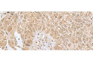 Immunohistochemistry of paraffin-embedded Human lung cancer tissue using PHF6 Polyclonal Antibody at dilution of 1:85(x200) (PHF6 抗体)