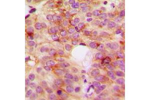 Immunohistochemical analysis of ACOT8 staining in human breast cancer formalin fixed paraffin embedded tissue section. (ACOT8 抗体  (Center))