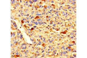 Immunohistochemistry of paraffin-embedded human melanoma using ABIN7176271 at dilution of 1:100 (ZNF384 抗体  (AA 1-245))