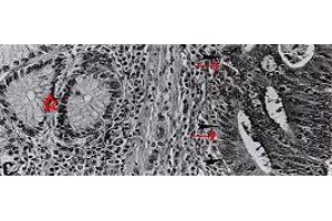 High-power view of colorectal carcinoma cells. (HNE 抗体)