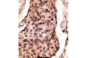 Formalin-fixed and paraffin-embedded human cancer tissue reacted with the primary antibody, which was peroxidase-conjugated to the secondary antibody, followed by DAB staining. (SIGLEC8 抗体  (C-Term))