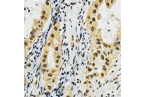Immunohistochemical analysis of LMO3 staining in human lung cancer formalin fixed paraffin embedded tissue section. (LMO3 抗体  (C-Term))