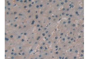 Detection of PRSS1 in Human Liver cancer Tissue using Polyclonal Antibody to Protease, Serine 1 (PRSS1) (PRSS1 抗体  (AA 51-228))